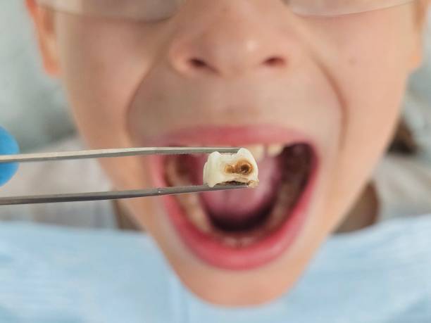 Best Emergency Tooth Extraction in Toona, AL